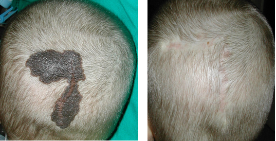 Anyajegy eltávolítása fejbőrről. Forrás: dr. Novoth Béla, Gyógyhírek portál. 