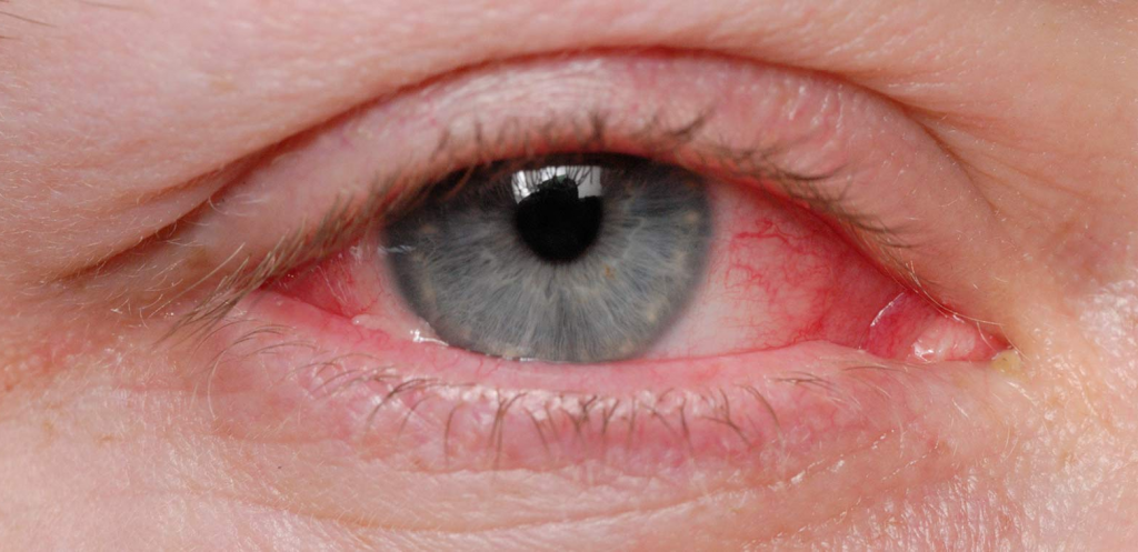 szem kötőhártya gyulladás fertőző